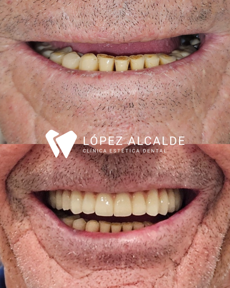 MAXI ANTES Y DESPUES